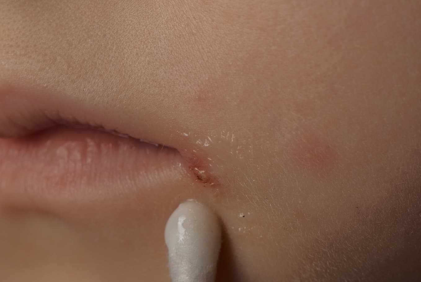 Närbild av svinkoppor vid munnen – bakterieinfektion med sår och blåsor, behandlas effektivt med receptbelagd medicin online via Doktera.se