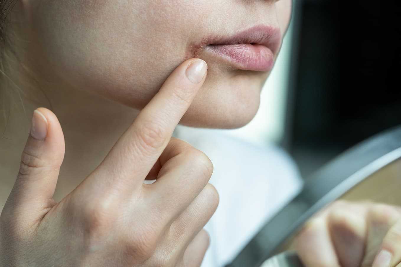 Munsår vid läppen undersöks i spegeln – typiskt för herpes simplex. Få snabb läkarbedömning online hos Doktera vid munsår eller blåsor.